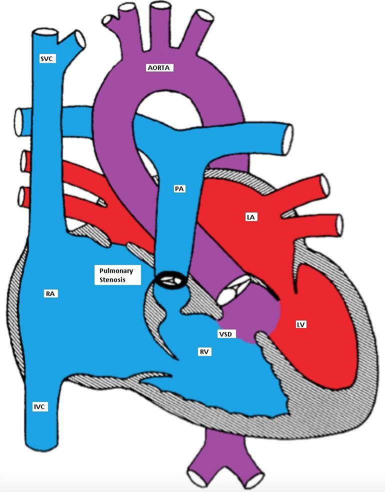 Tetralogy of Fallot